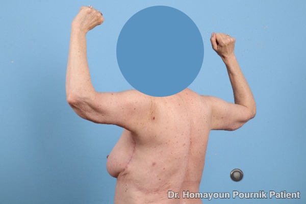 Arm Lift Patient Photo - Case 25680 - after view-3
