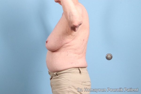 Arm Lift Patient Photo - Case 25680 - before view-2
