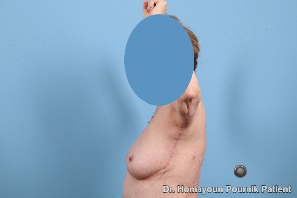Arm Lift Patient Photo - Case 25680 - after view-2