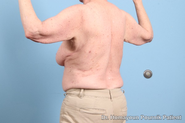 Arm Lift Patient Photo - Case 25680 - before view-3