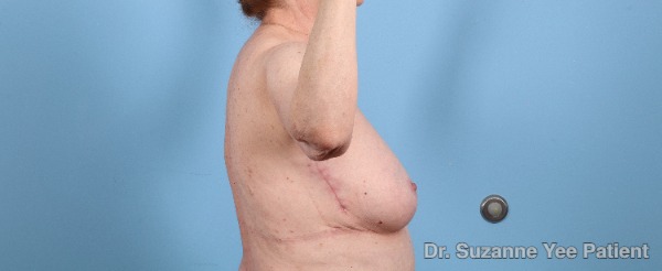 Arm Lift Patient Photo - Case 25680 - after view-4