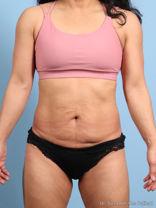 RF Microneedling Patient Photo - Case 25698 - before view-2