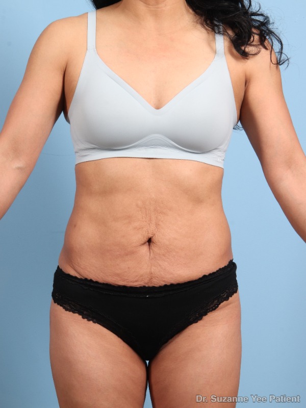 RF Microneedling Patient Photo - Case 25698 - after view-2