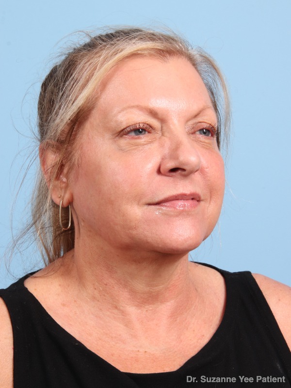 Laser Skin Treatments Patient Photo - Case 25720 - after view-4