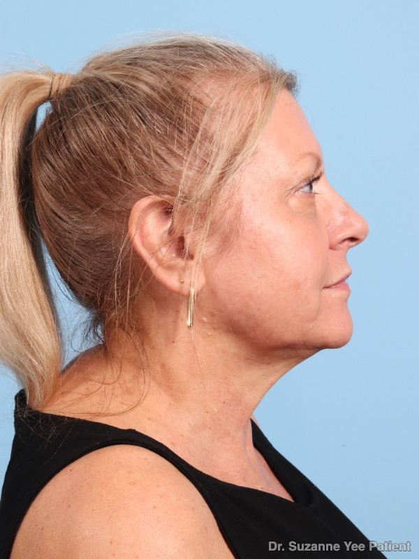 Laser Skin Treatments Patient Photo - Case 25720 - after view-1