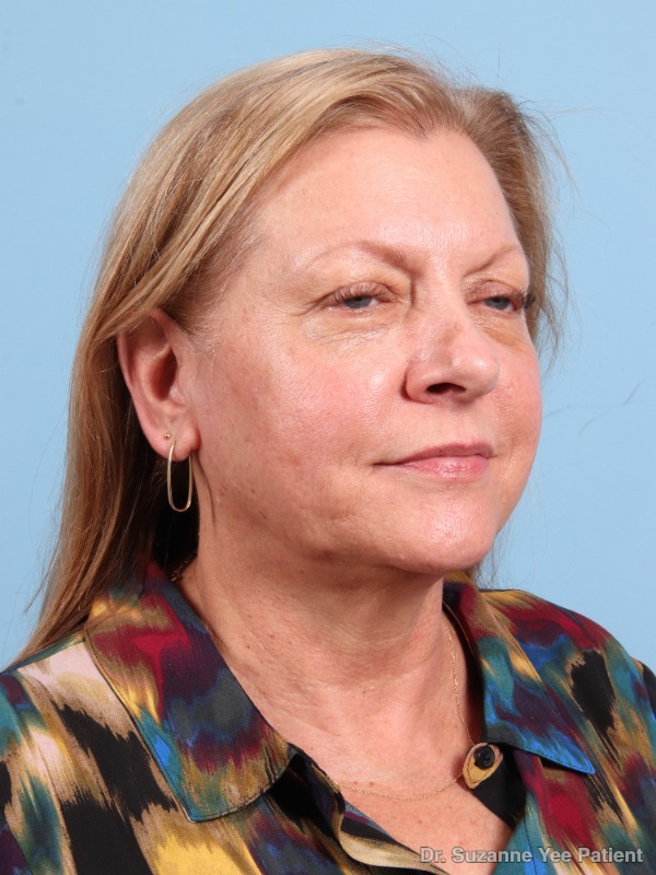 Laser Skin Treatments Patient Photo - Case 25720 - before view-4