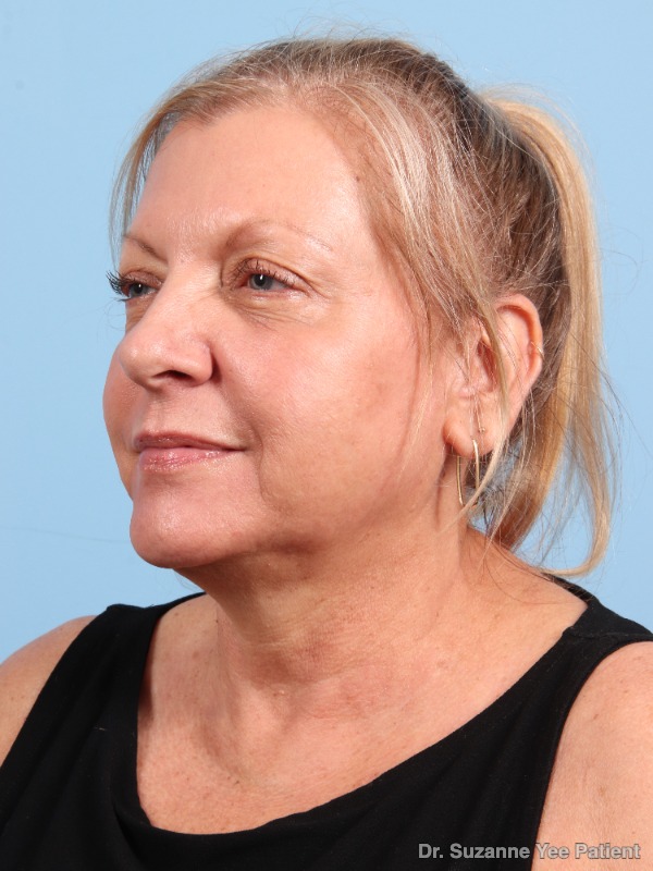 Laser Skin Treatments Patient Photo - Case 25720 - after view-2