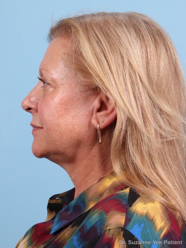 Laser Skin Treatments Patient Photo - Case 25720 - before view-3