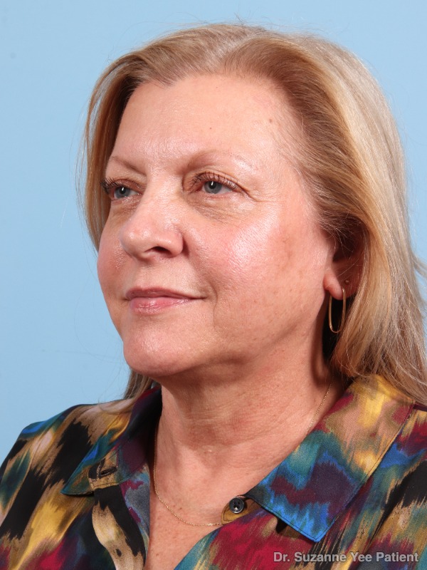 Laser Skin Treatments Patient Photo - Case 25720 - before view-2