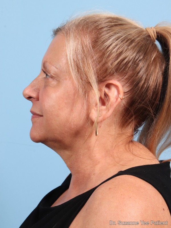 Laser Skin Treatments Patient Photo - Case 25720 - after view-3