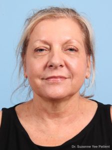 Laser Skin Treatments - Case 25720 - After