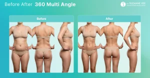 Lipo 360: A Complete Guide to 360-Degree Body Contouring