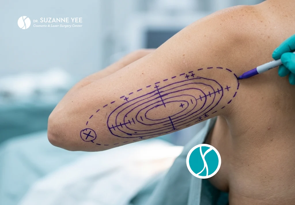 What are your options for arm, back, and chin liposuction?