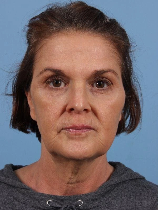 Before dermal filler treatment, actual patient of Dr. Suzanne Yee, Little Rock AR