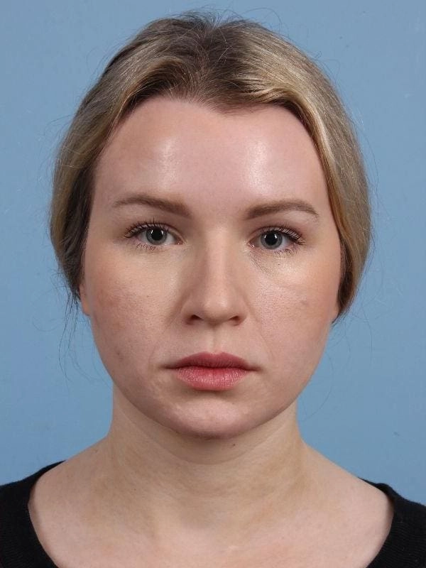 After neurotoxin treatment, actual patient of Dr. Suzanne Yee