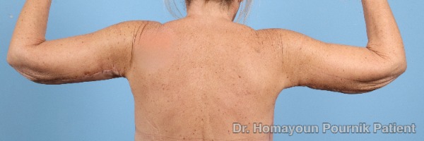 Arm Lift Patient Photo - Case 26459 - before view-1