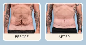 Tummy Tuck 5 Years Later: How Your Results Hold Up